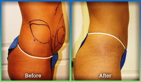 Image 2 | Laser Lipo and Vein Center