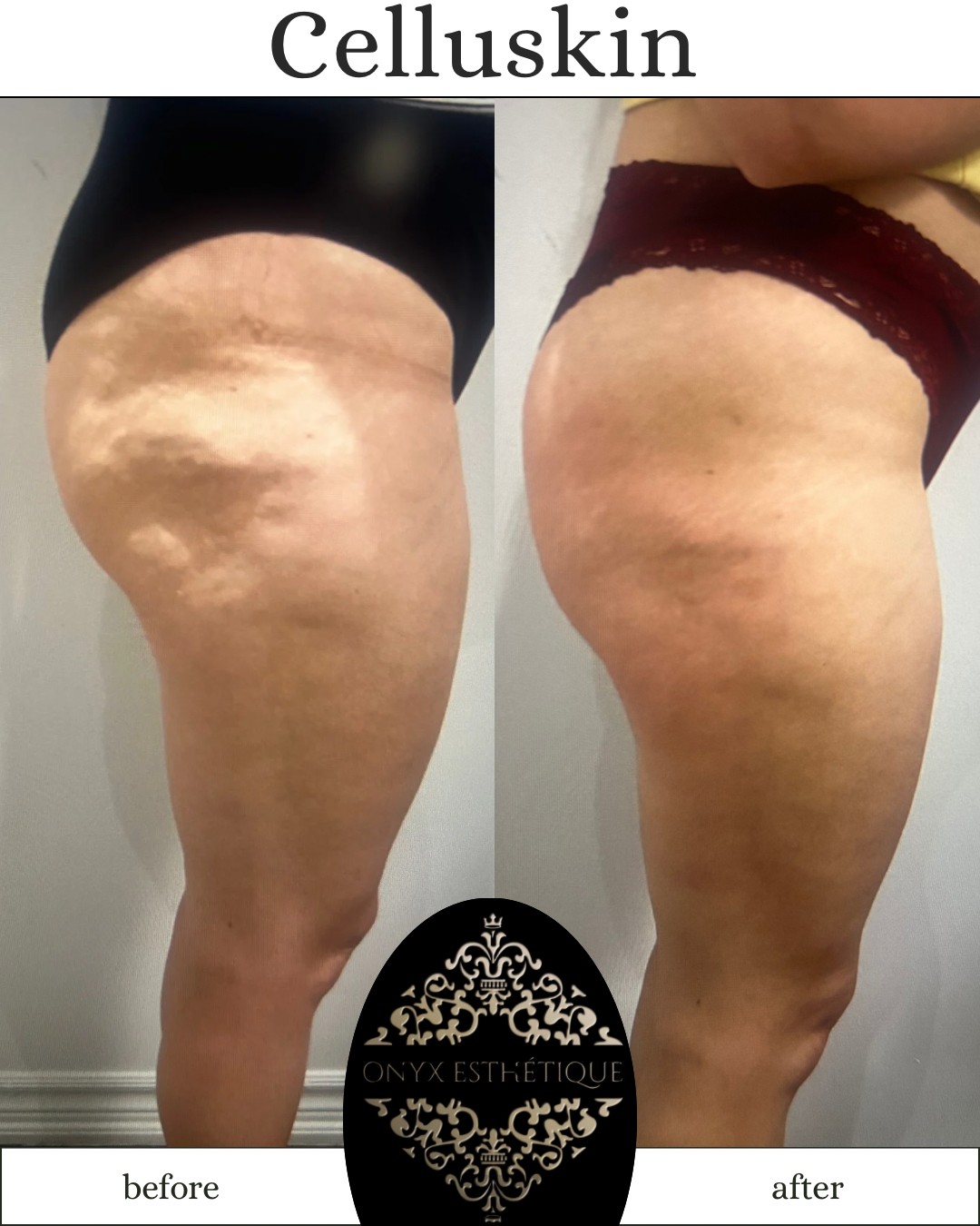 Images Onyx Esthétique - Soins esthétiques, Soins de la peau, Laser Cynosure Gatineau