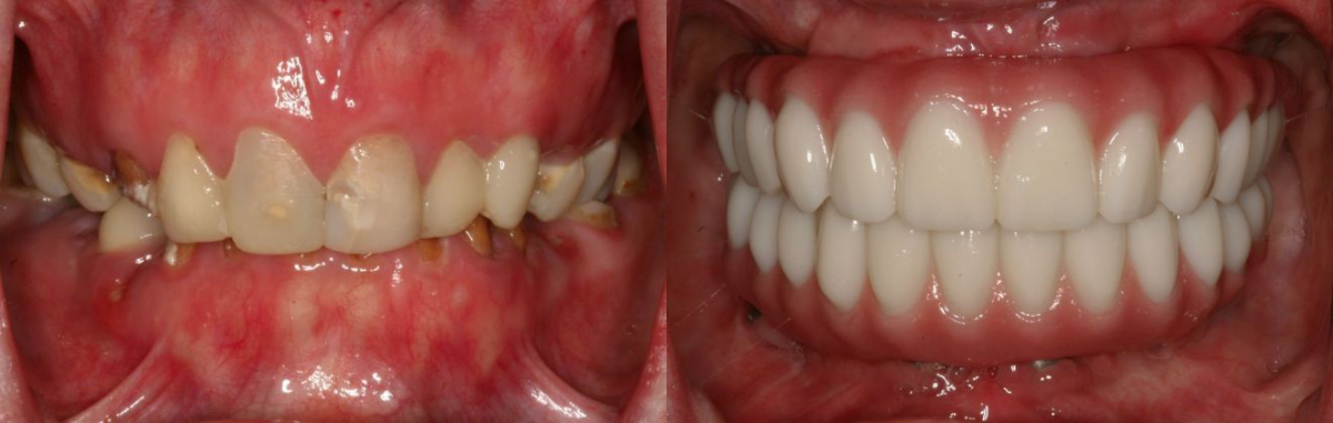 Before & After from Advanced Cosmetic and Implant Dentistry | Glastonbury, CT