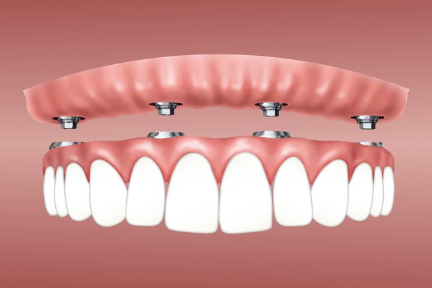 Images Trevisani Oral Surgery & Dental Implants