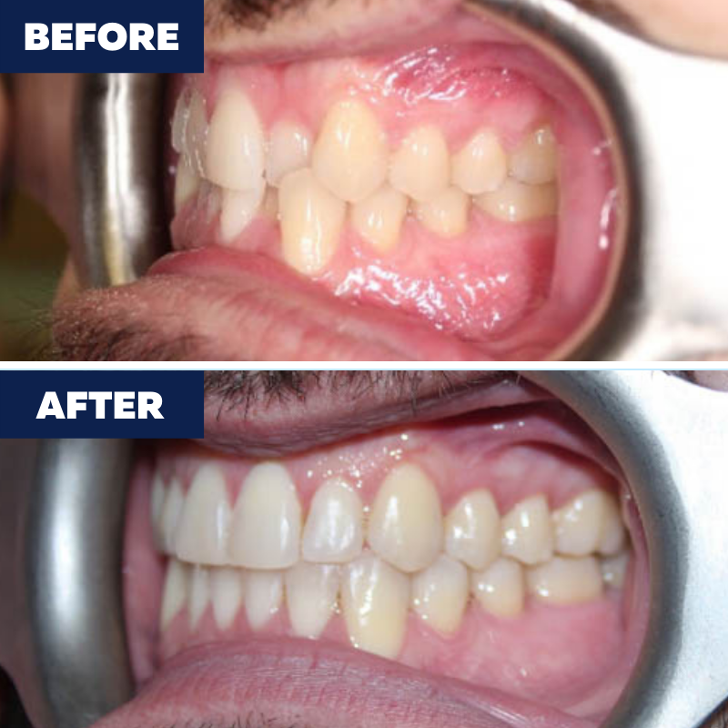 Invisalign used to treat severe crowding and crossbite. Call us to schedule a consultation! (424) 31 Orthodontics of Torrance Torrance (424)201-0712