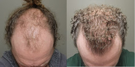 Images BKS Hair Restoration