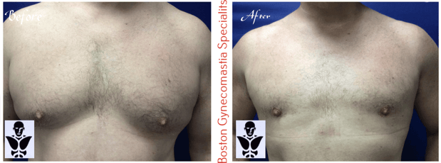 Images Boston Gynecomastia Specialists