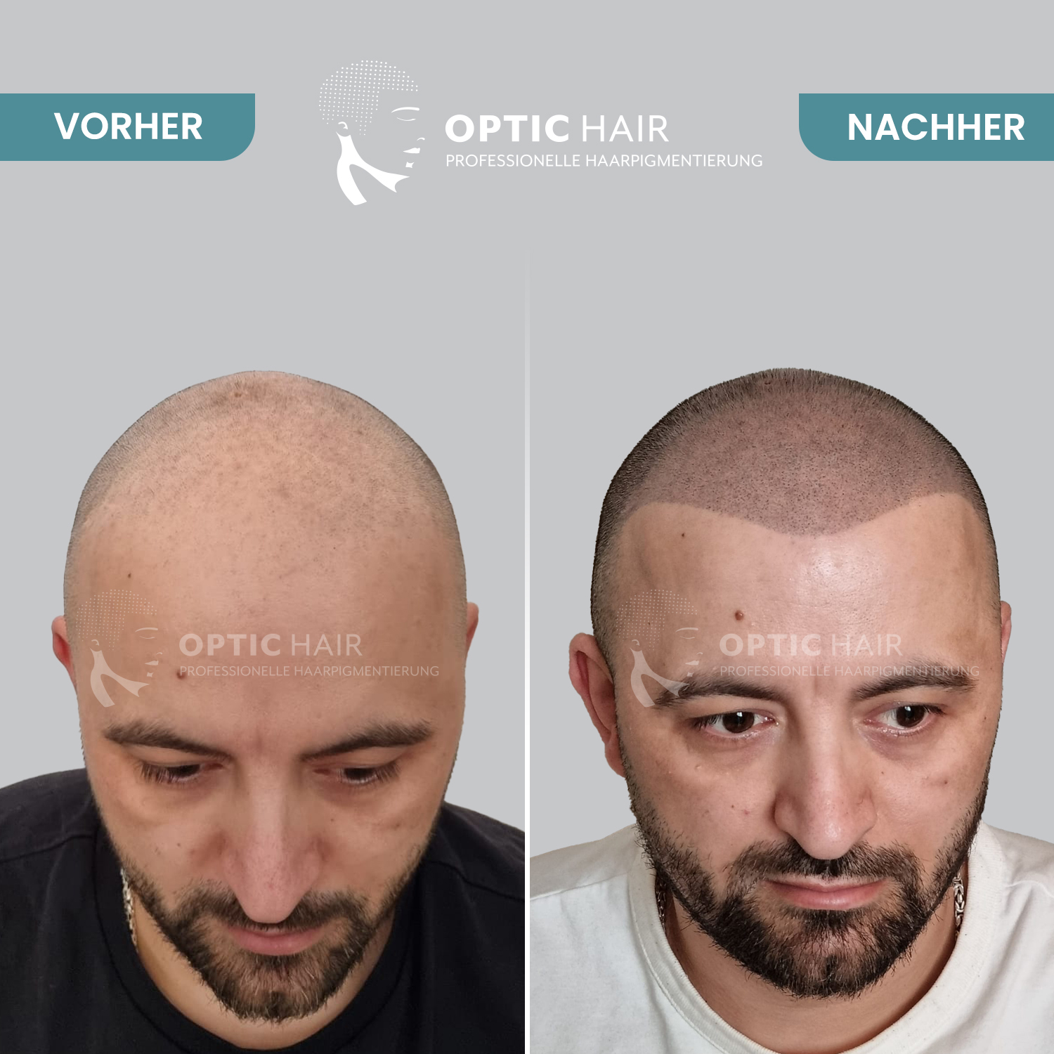 Bild 2 Haarpigmentierung Köln | OpticHair in Köln