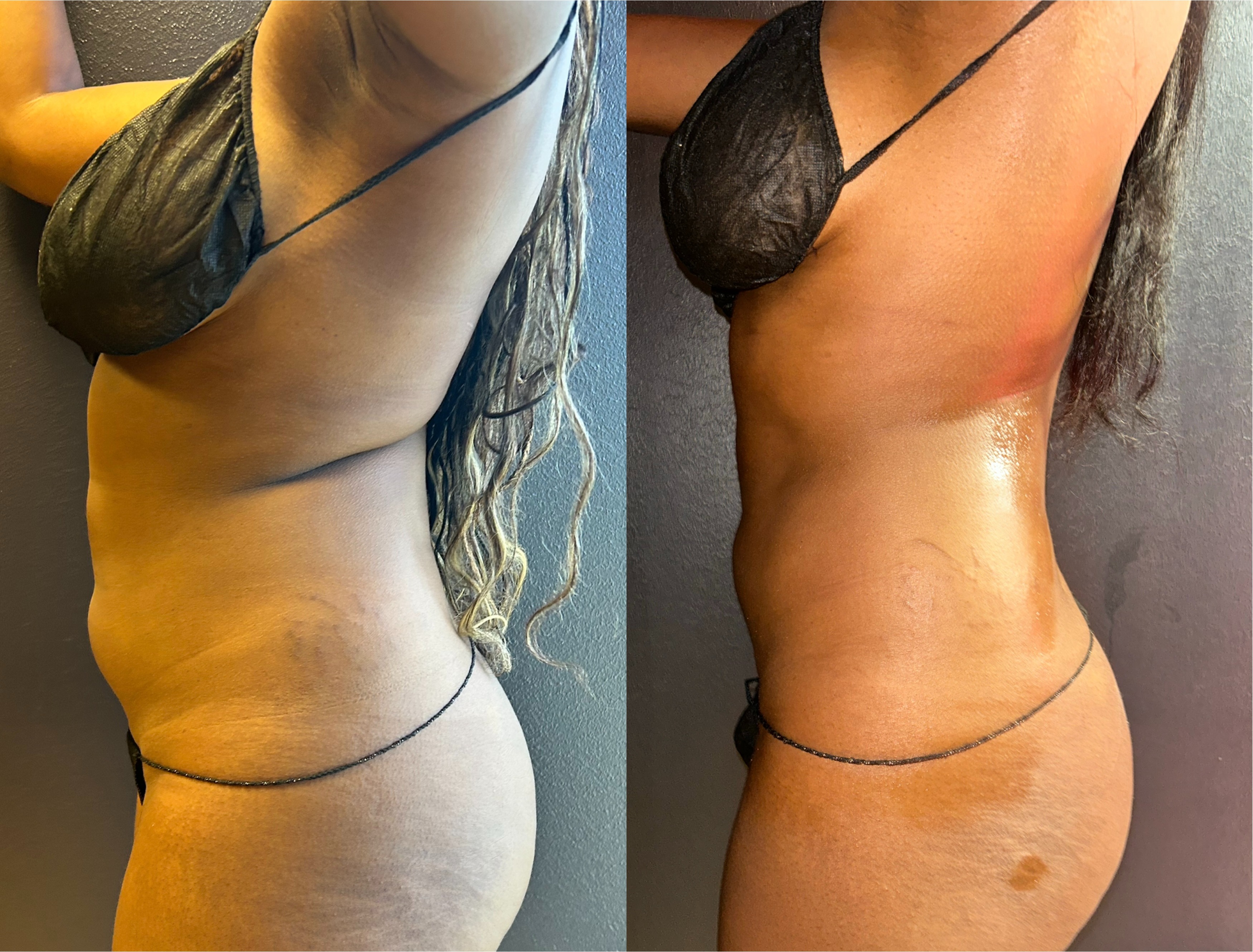 Before-and-after abdominal body contouring results showing a slimmer, more defined waistline following nonsurgical body sculpting at Grace MedSpa in Austin, Texas.