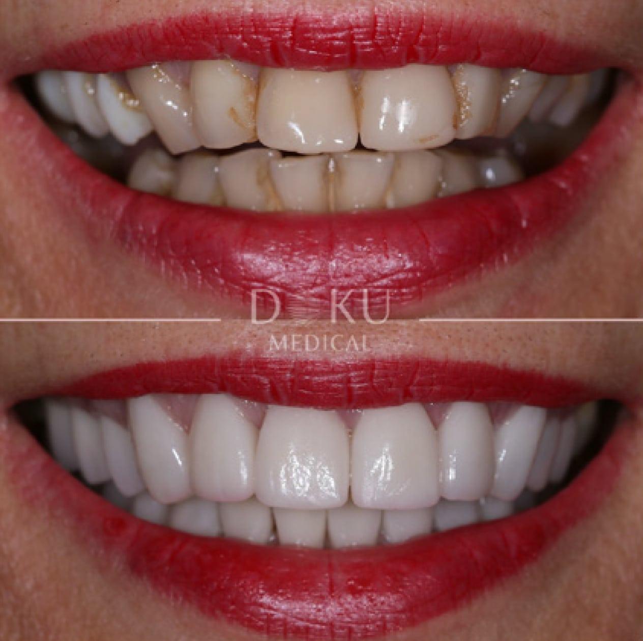 Bild 1 Veneers & Zahnimplantate – Zähne machen lassen in der Türkei mit Fly2Smile in Berlin