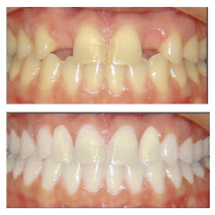Before and After at NÜVA Smile | Bergenfield, NJ