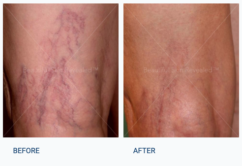 Before and After | Leg Vein Treatment at Dermatology & Laser Surgery Center