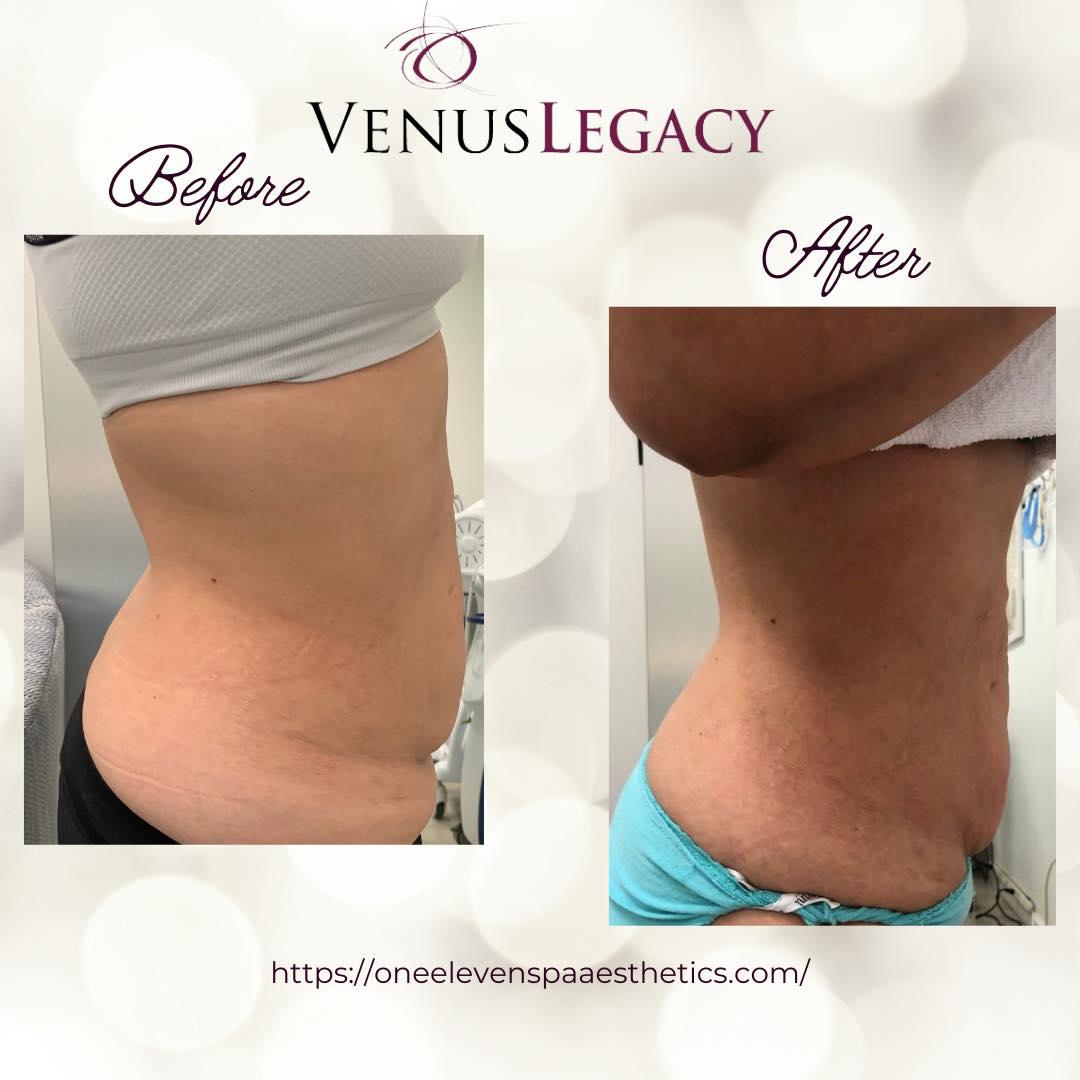 Localized fat pockets aren’t always responsive to diet and exercise alone. With the help of advanced fat reduction procedures, we’re able to help you achieve the desired contours without pain, side effects