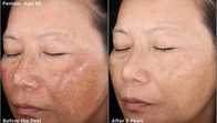 Glycolic peels are suitable for most people, even those without a specific concern, plus you get great results without any downtime.