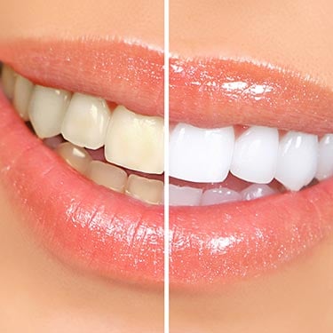 Images Carrefour Dentaire 440 - Invisalign, Dentiste Laval