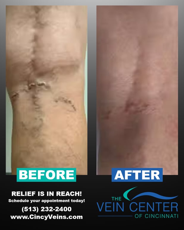 Images The Vein Center of Cincinnati, LLC