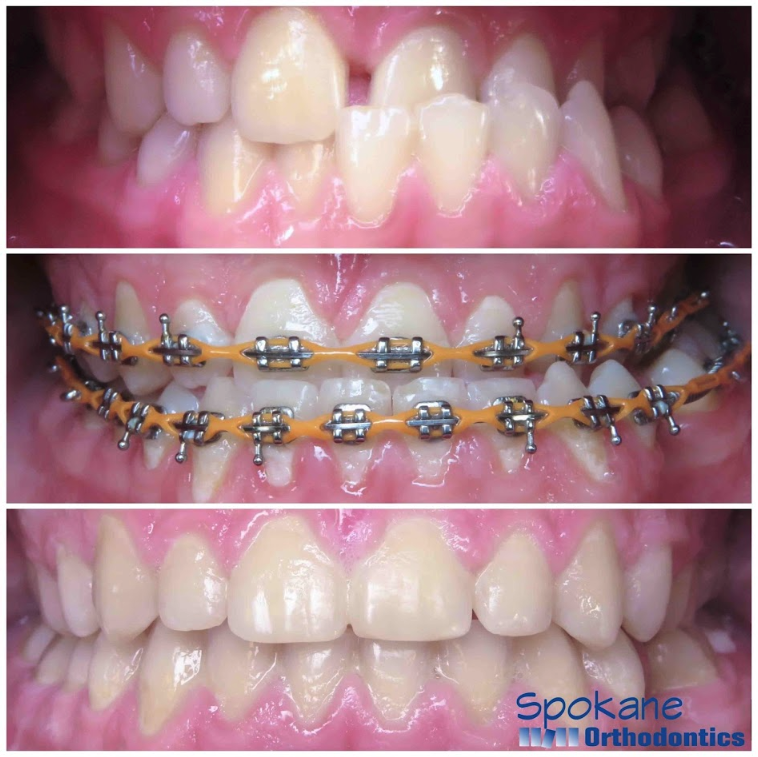 Before & After from Karski & Spokane Orthodontics | Seven Fields, PA