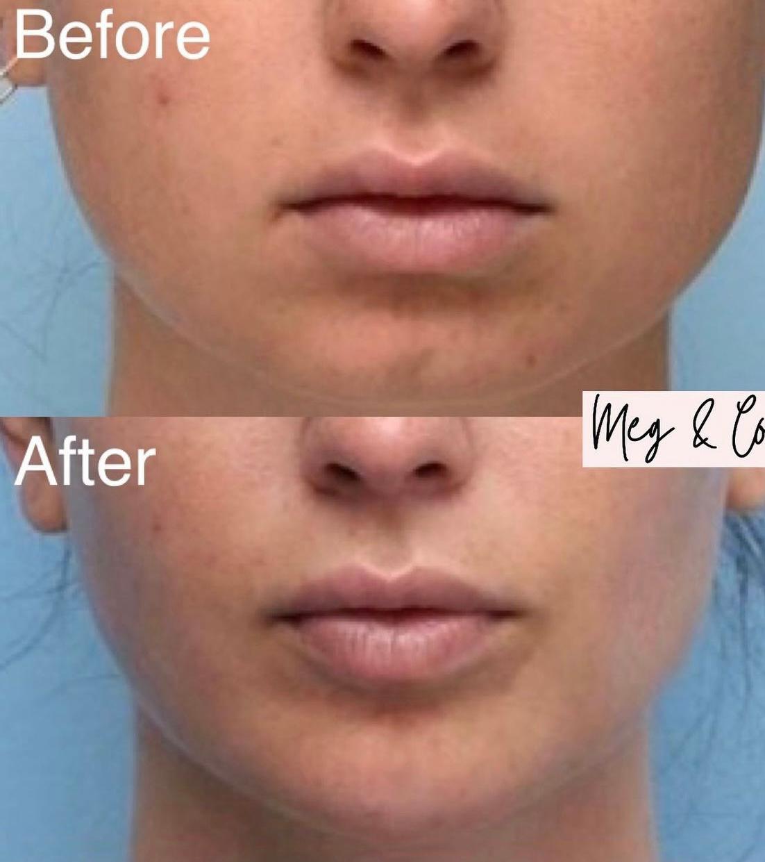 Jawline slimming with botox injections