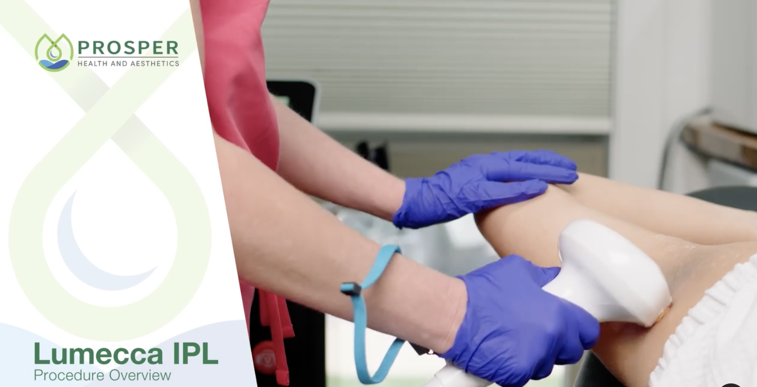 Lumecca IPL