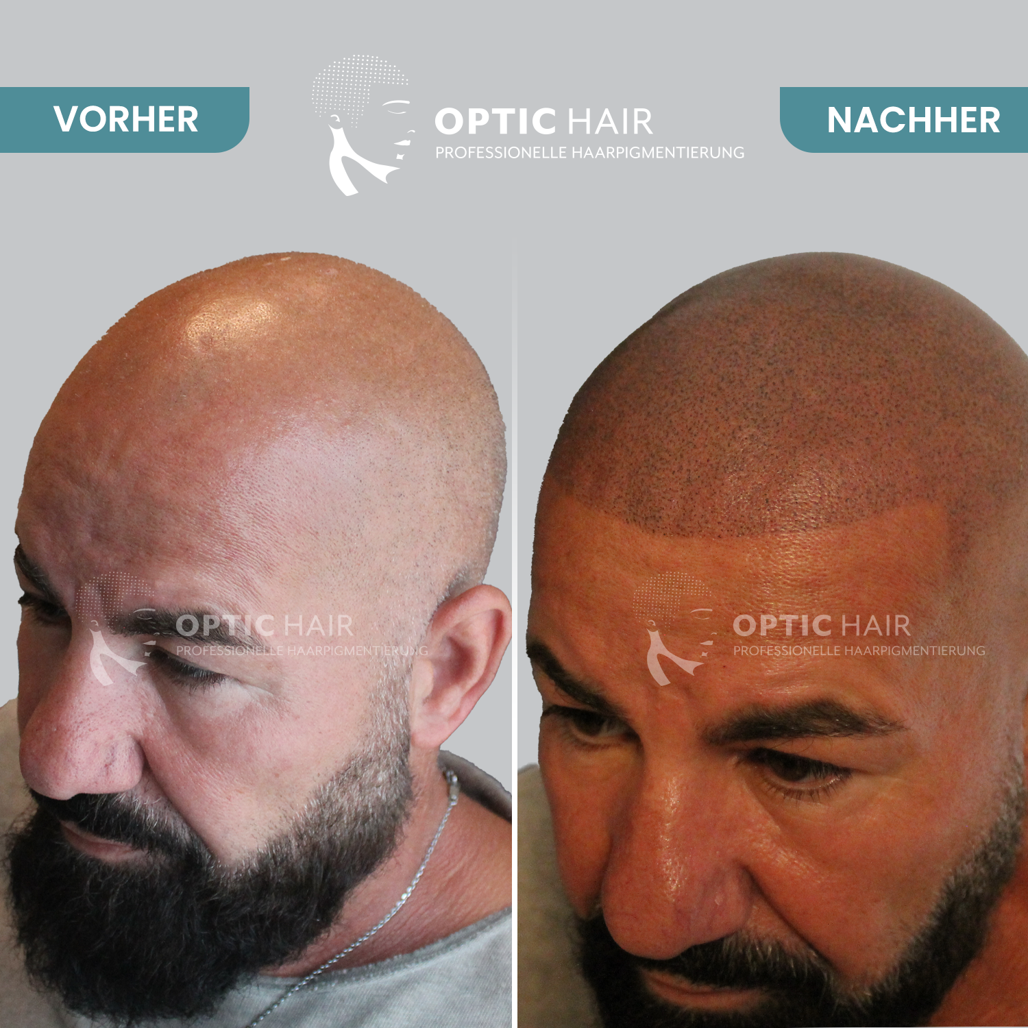 Bild 25 Haarpigmentierung Köln | OpticHair in Köln