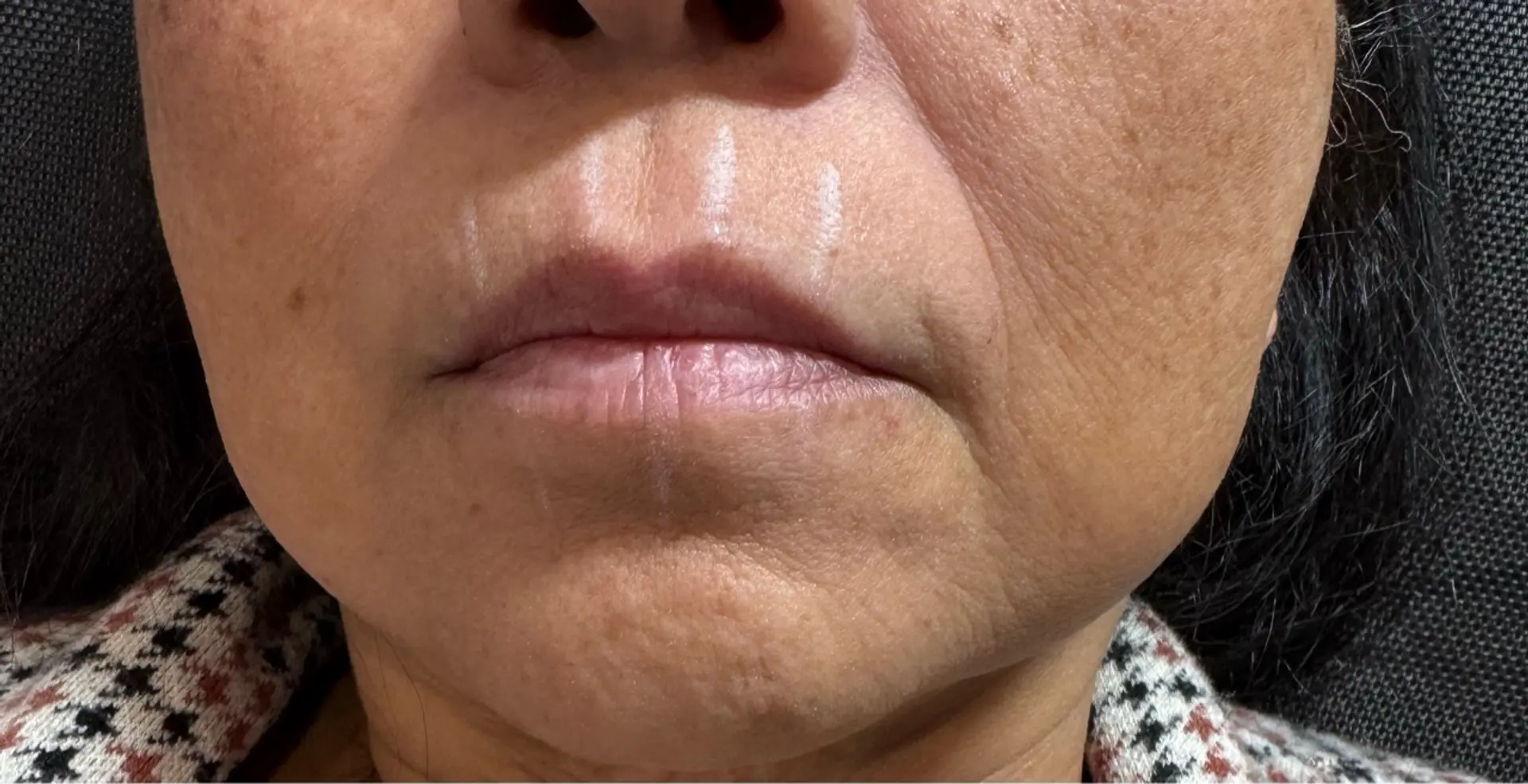 Close-up of a person's mouth and chin area, showing skin texture and some light markings above the upper lip. The person is wearing a patterned top. The background appears to be a dark, textured fabric.