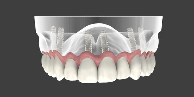 Images Progressive Periodontics and Implant Dentistry