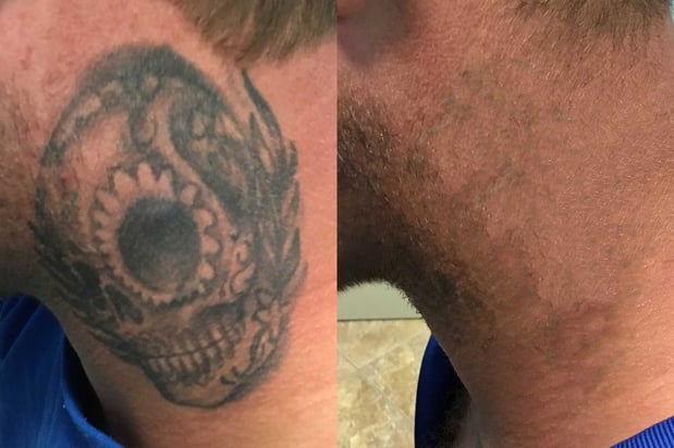Images TakeTatt Tattoo Removal