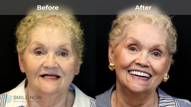 Images Smile Now Tacoma Dentures and Implants