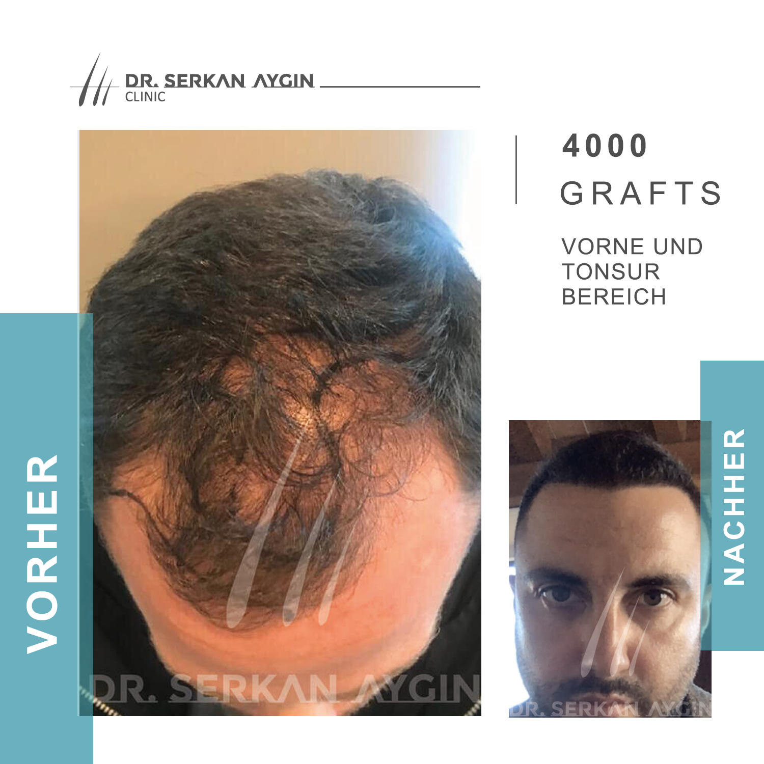 Kundenbild groß 11 Dr Serkan Aygin | Niederlassung Berlin | Haartransplantation Türkei