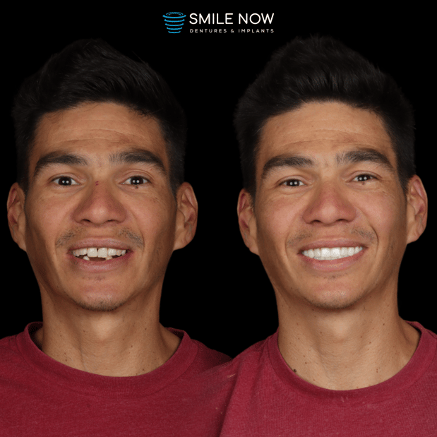 Images Smile Now Milwaukee Dentures and Implants