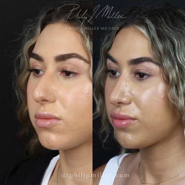 Images Dr. Philip Miller - #1 Facelift and Rhinoplasty Surgeon in New York