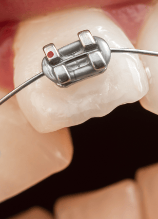 Images Diamond Braces Orthodontist: Braces & Invisalign