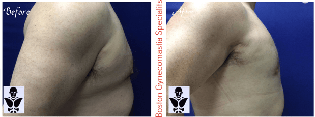 Images Boston Gynecomastia Specialists