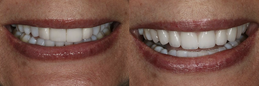 Before & After Results of Advanced Dentistry of Blakeney | Charlotte, NC