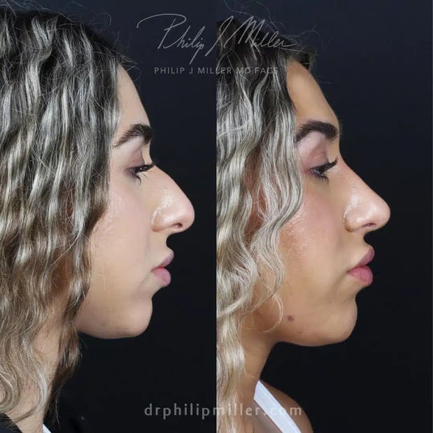 Images Dr. Philip Miller - #1 Facelift and Rhinoplasty Surgeon in New York
