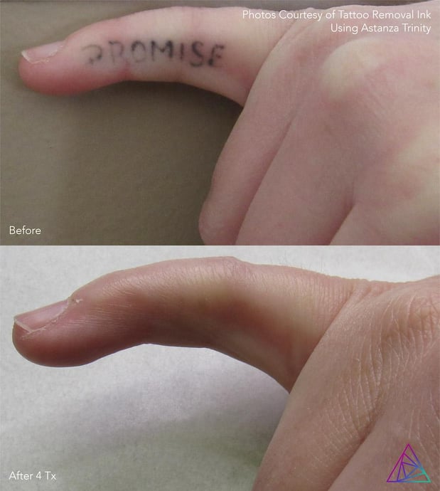 Images Integrity Ink - Laser Tattoo Removal in Crosby, TX