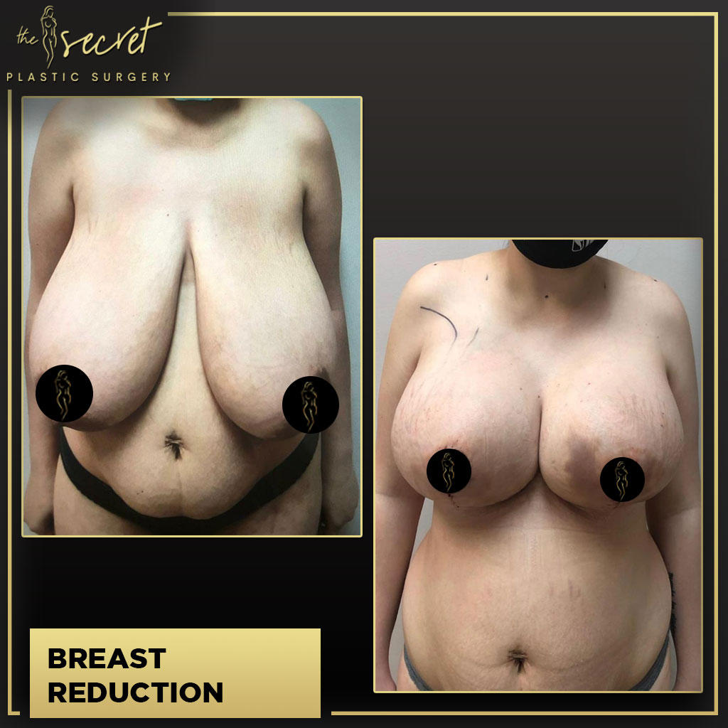 Breast Reduction- The Secret Plastic Surgery