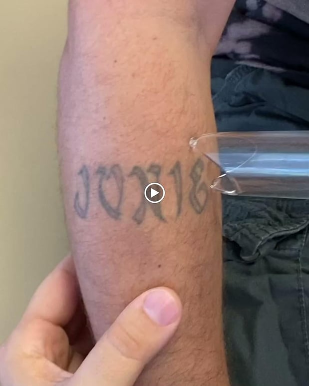 Images TakeTatt Tattoo Removal