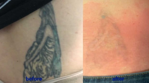 Images TakeTatt Tattoo Removal