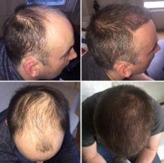 Images Capital Hair Restoration