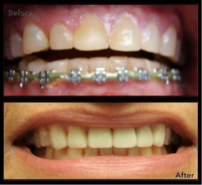Before-and-after orthodontic treatment showing teeth during braces treatment and the improved smile  