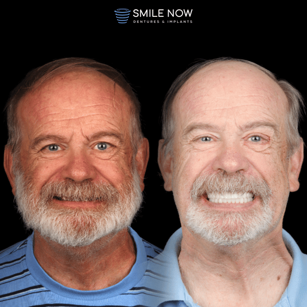 Images Smile Now Milwaukee Dentures and Implants