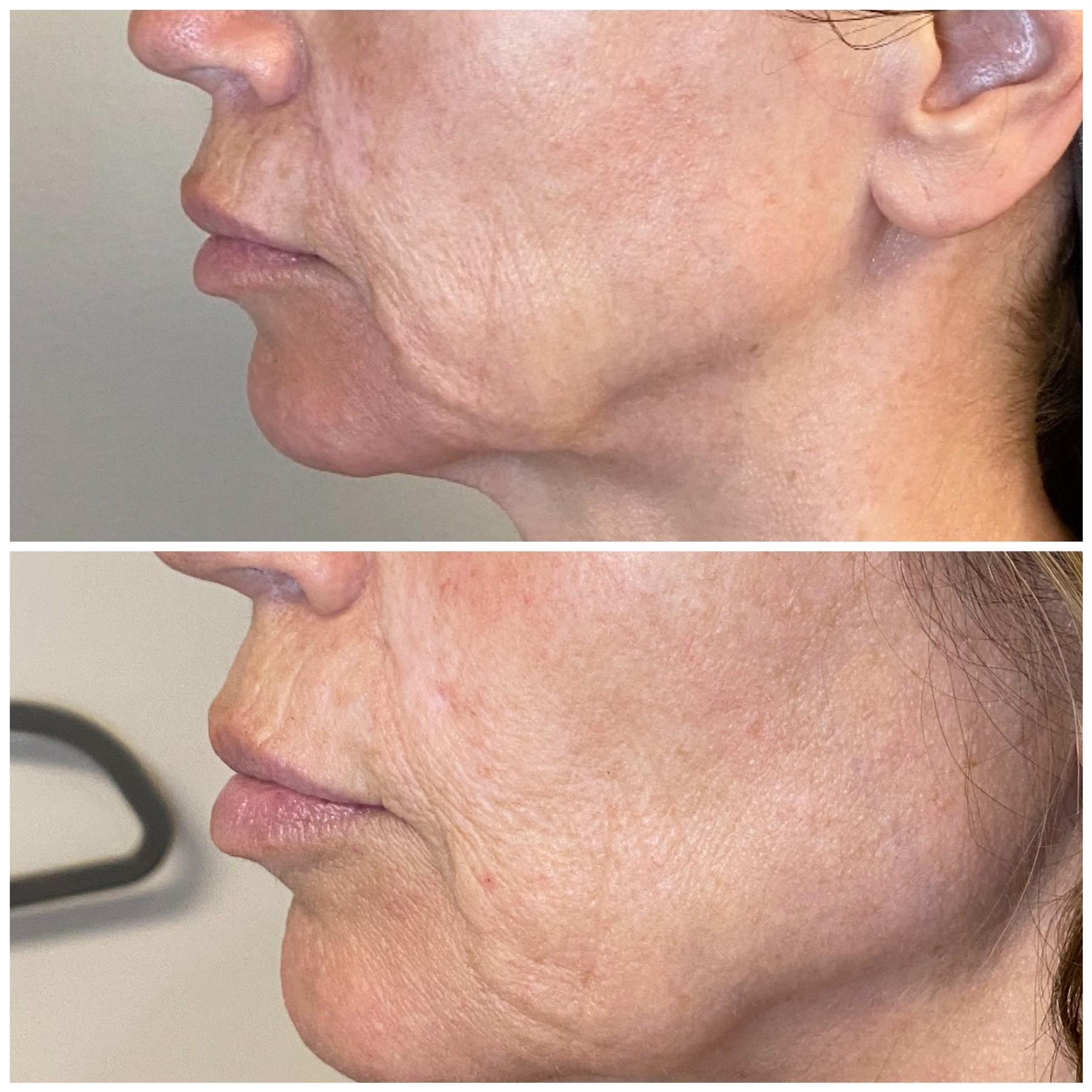 Tixel face treatment for redness and skin tightening