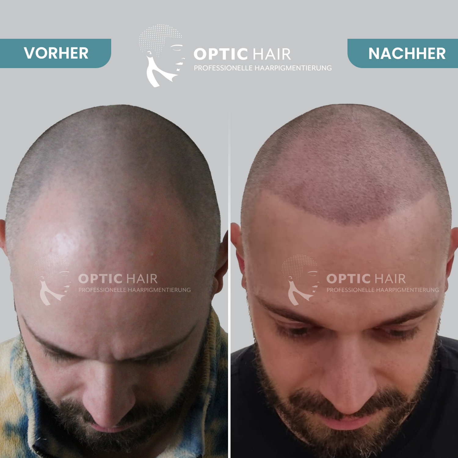 Kundenbild groß 22 Haarpigmentierung Köln | OpticHair