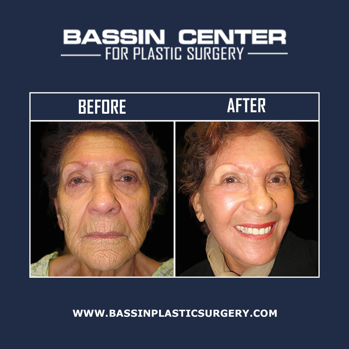 The Bassin Center for Plastic Surgery in Tampa helps patients defy the effects of aging by providing patients personalized facelift procedures to achieve long-lasting, lifted results. Facelift options include minimally-invasive laser options, non-surgical, and surgical facial rejuvenation.