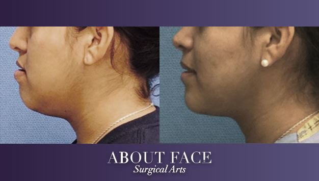 About Face Surgical Arts: Khurram A. Khan BDS, DMD Cincinnati (513)232-8989