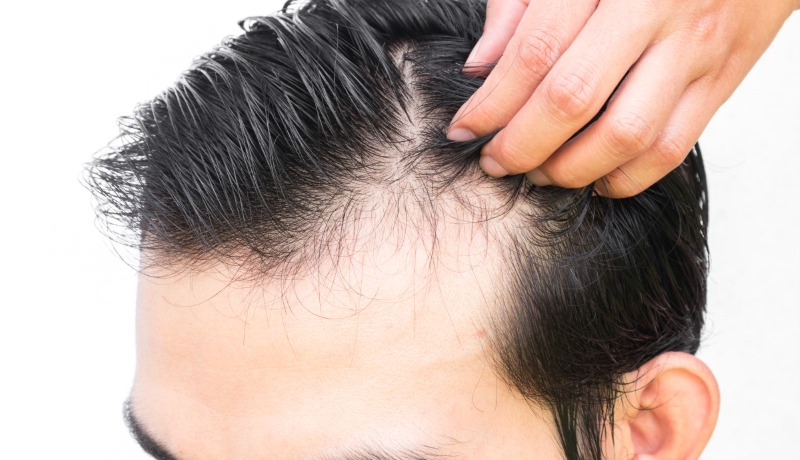 Images Follicl MD - Hair transplant - Greffe de cheveux