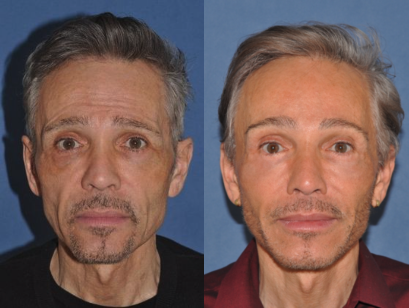 Brow Lift Before & After at Clinic of Facial Plastic Surgery | Buffalo, NY