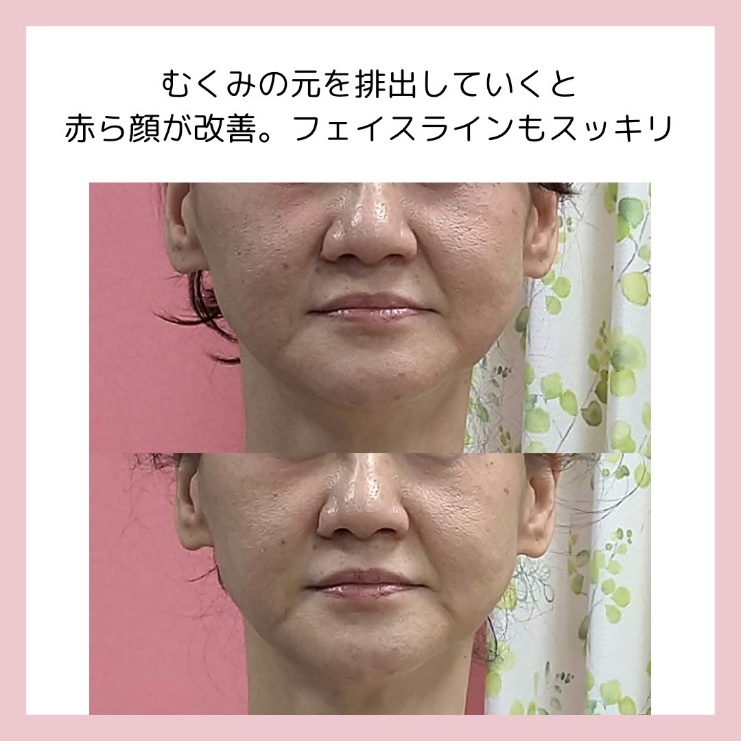 Images 目元・口元のたるみ&眉間シワ改善専門サロン