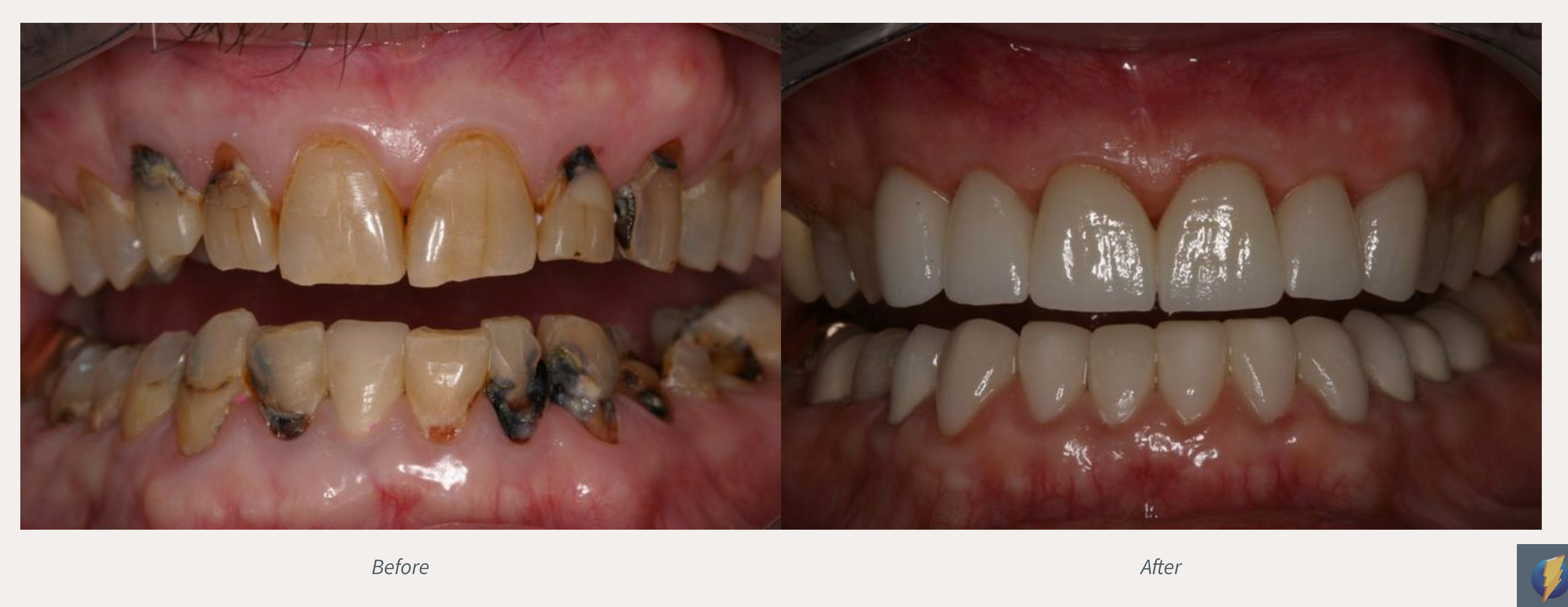 Smile Makeover Before & After from Advanced Dental Care | Valdosta, GA