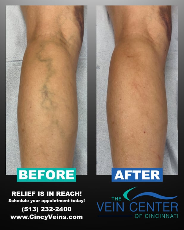 Images The Vein Center of Cincinnati, LLC