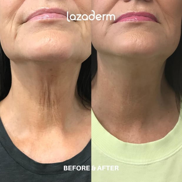 Images Lazaderm