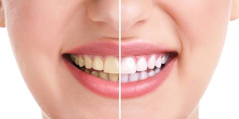 A Dentist Explains the Difference Between Teeth Whitening and Bleaching Mark Stephens DMD Richmond (859)626-0069
