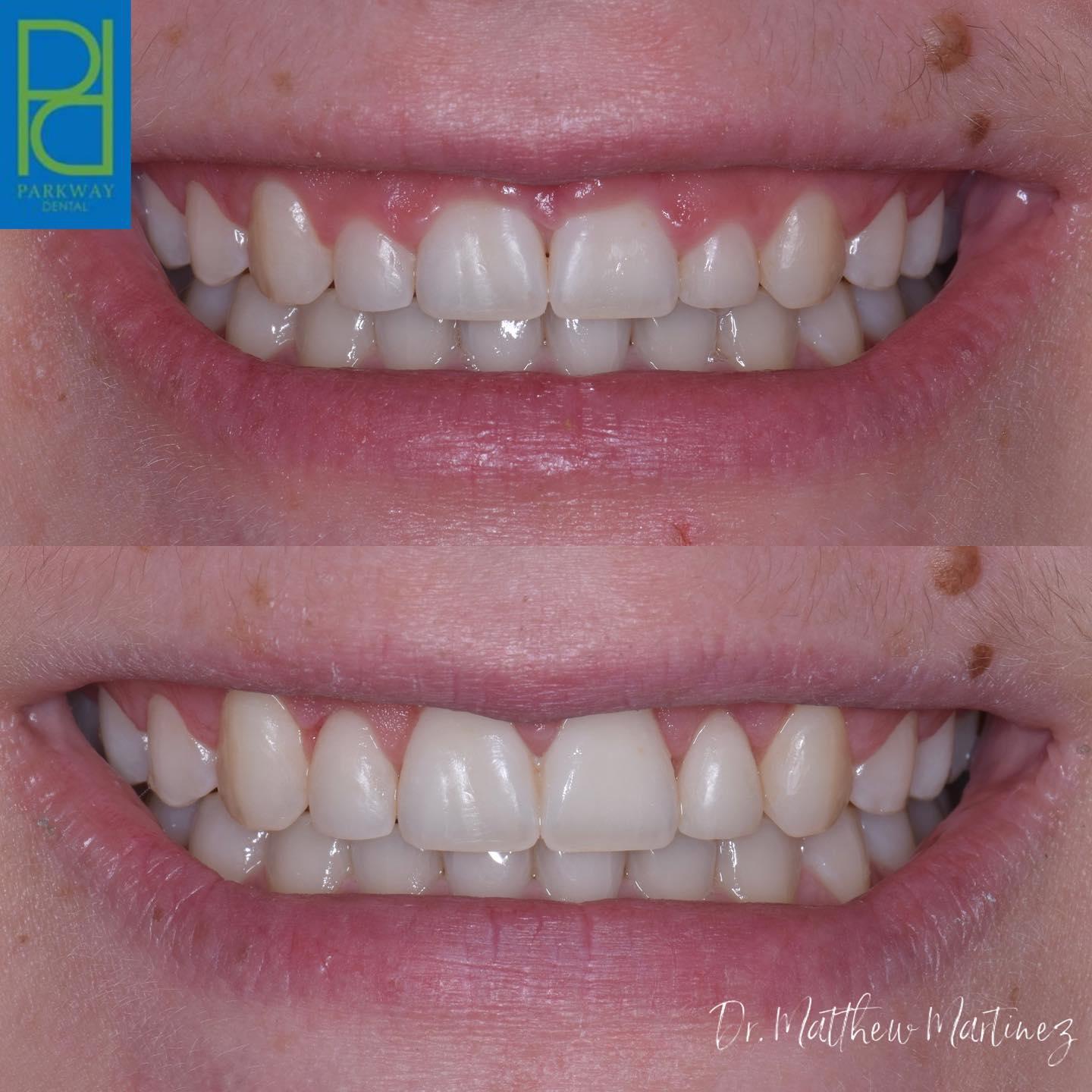 Before & After from Parkway Dental: Michael D Haight, DDS | Albuquerque, NM Parkway Dental: Michael D Haight, DDS Albuquerque (505)298-7479